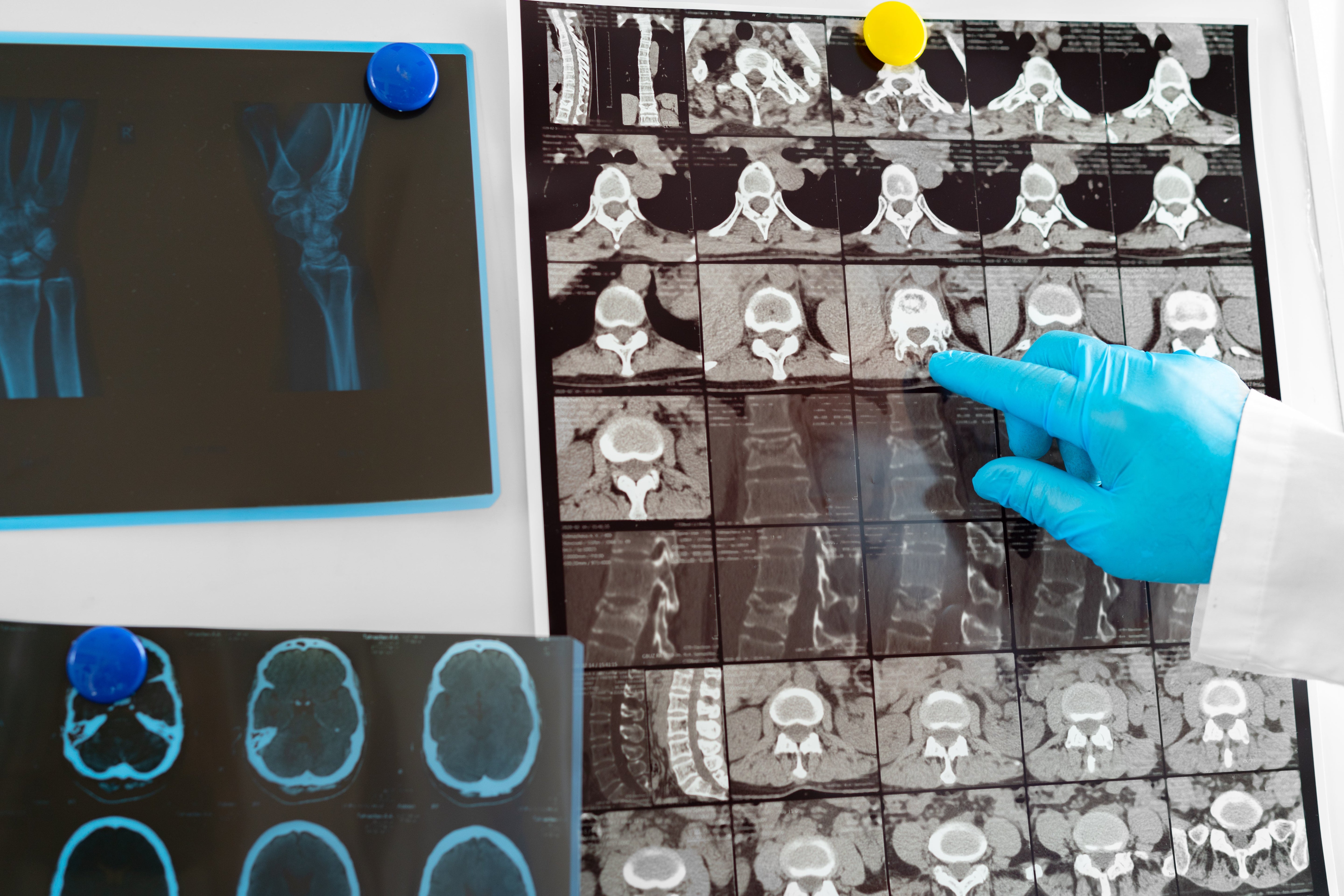 ¿Por qué una resonancia magnética puede mostrar lesiones… y no tienes dolor?