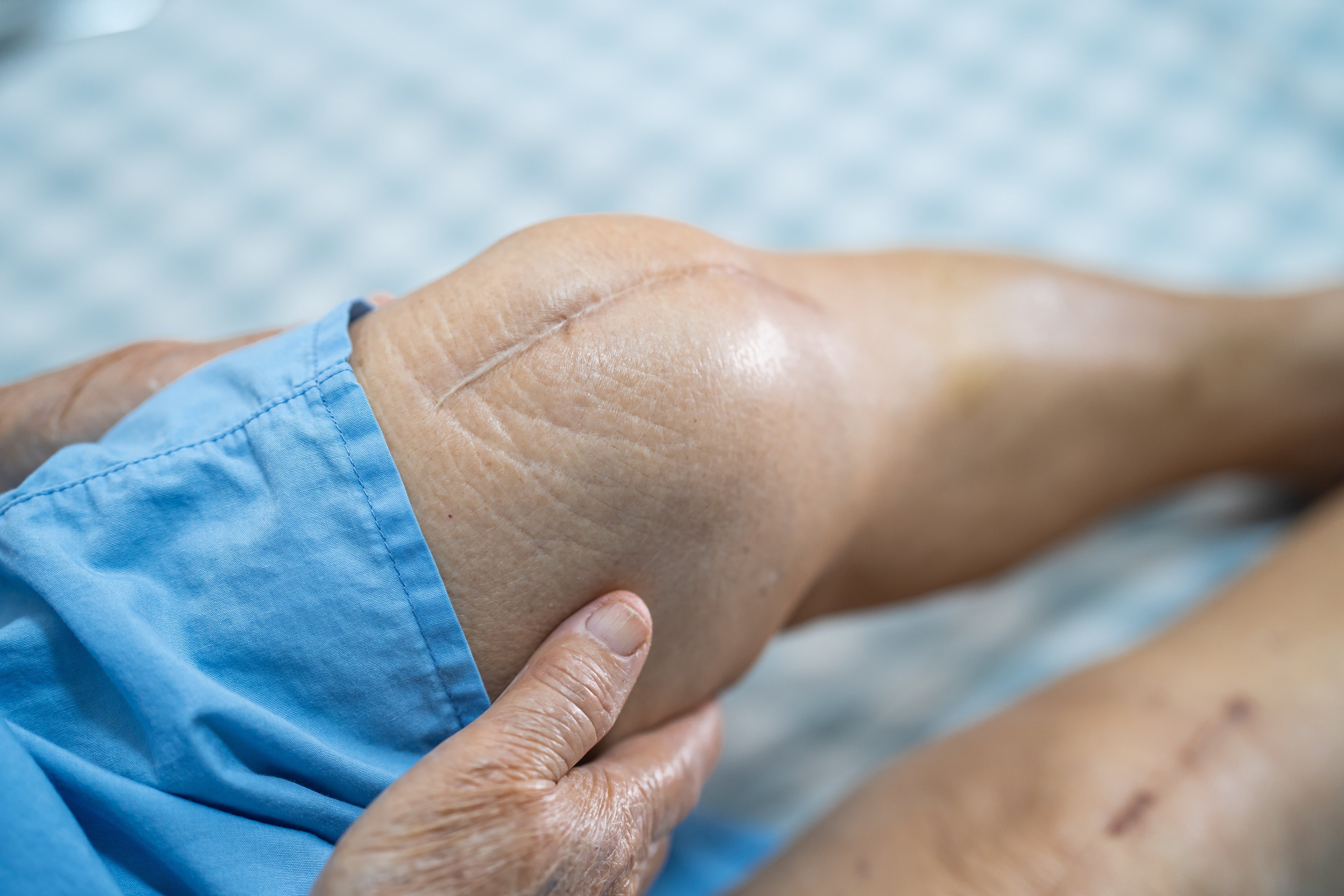 Pérdida de Cartílago y su impacto en el dolor articular